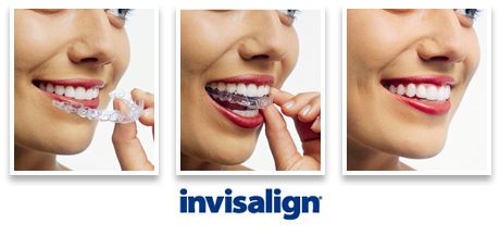 Difference Between Invisalign Clear Aligners & Clear Braces