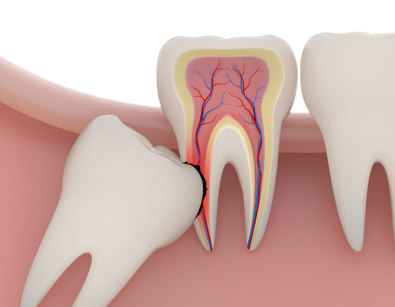 is wisdom teeth removal painful